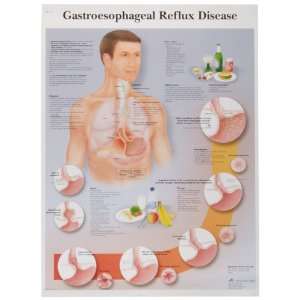 3B Scientific VR1711UU Glossy Paper Gastroesophageal Reflux Disease 