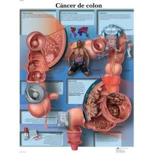 Cancer de colon (Spanish) 20 x 26 in.   Paper version 