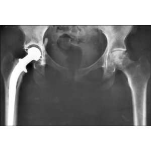  Artificial Hip Replacement X Ray   24x36 Poster 