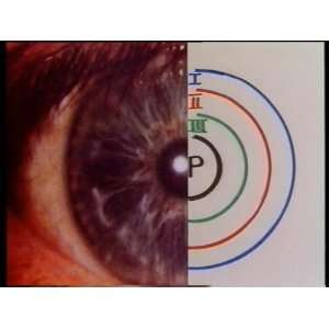Einführung in die Augen (Iris)diagnose [VHS] Rudi Schnürch  